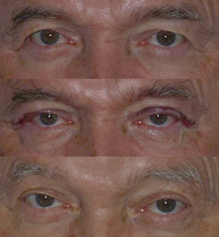 blepharoplasty