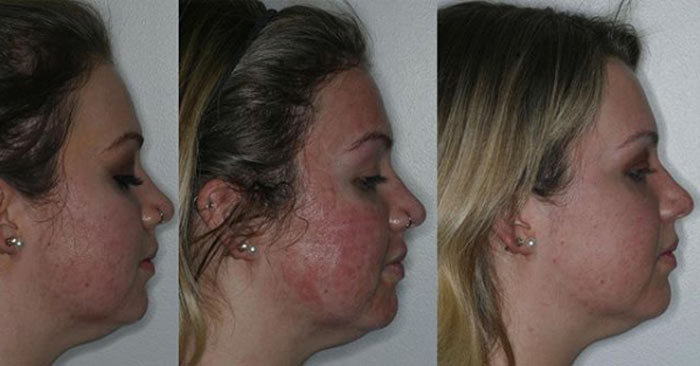 Laser-Skin-Resurfacing