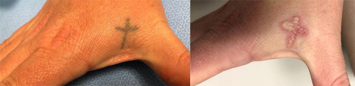 Tattoo-Removal