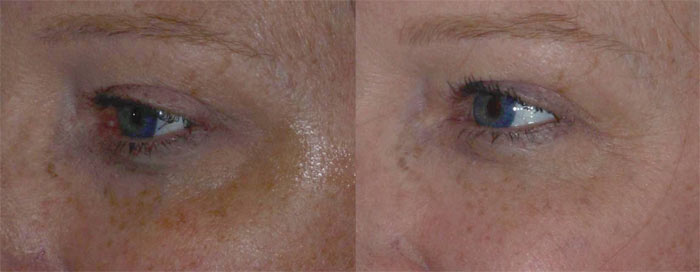 tear duct augmentation