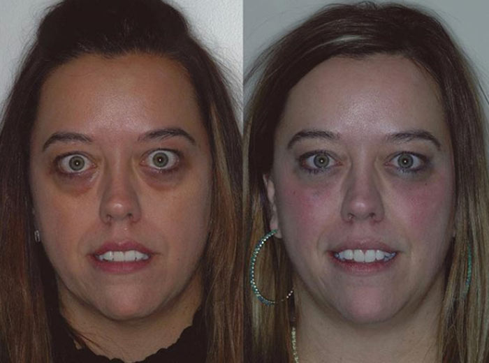 tear duct augmentation