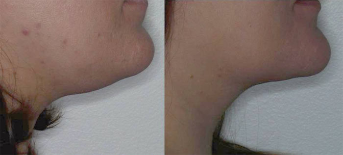 kybella lynchburg aesthetics
