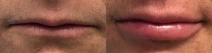 lip
