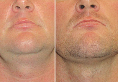 before after slider thumbs dr cmizgala hover nb