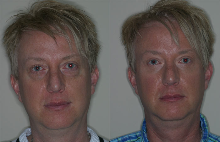 before and after blepharoplasty