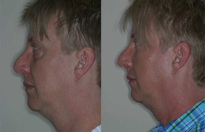 before and after blepharoplasty