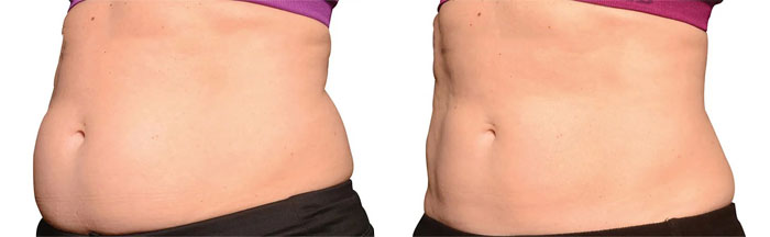 coolsculpting before and after