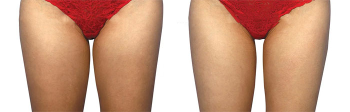 coolsculpting before and after