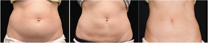 coolsculpting before and after