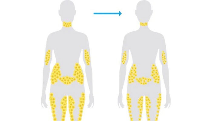 CoolSculpting