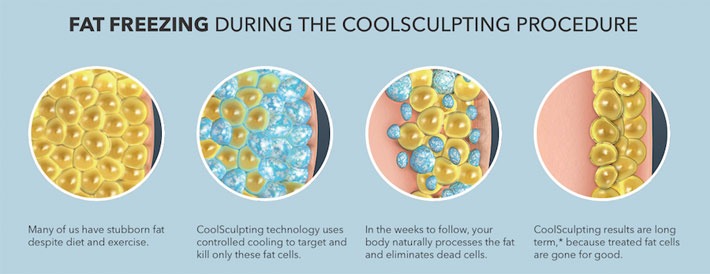 fat-freeze-coolsculpting