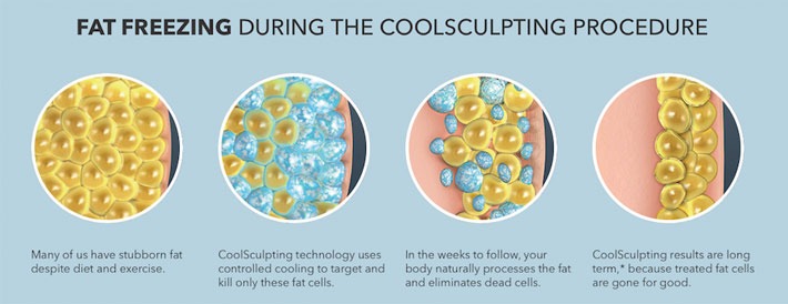 fat freeze coolsculpting
