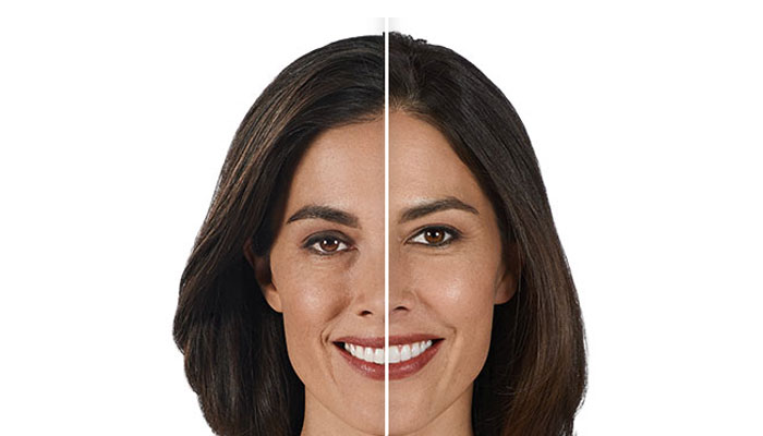 juvederm after and before