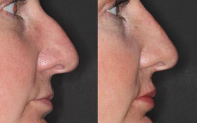 Nonsurgical Liquid rhinoplasty and subtle lip augmentation