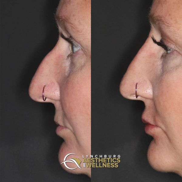 lynchburg aesthetics wellness non surgical rhinoplasty lip augmentation case study side view
