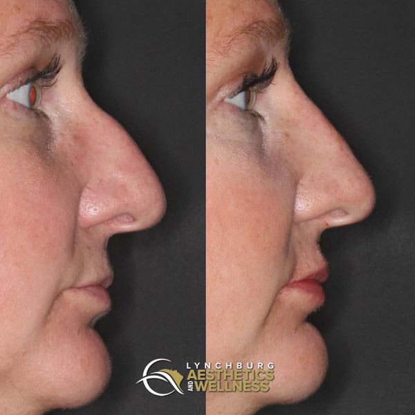 Nonsurgical Liquid rhinoplasty and subtle lip augmentation