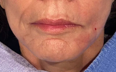 Get Smooth And Volumize Result After Sculptra Treatment