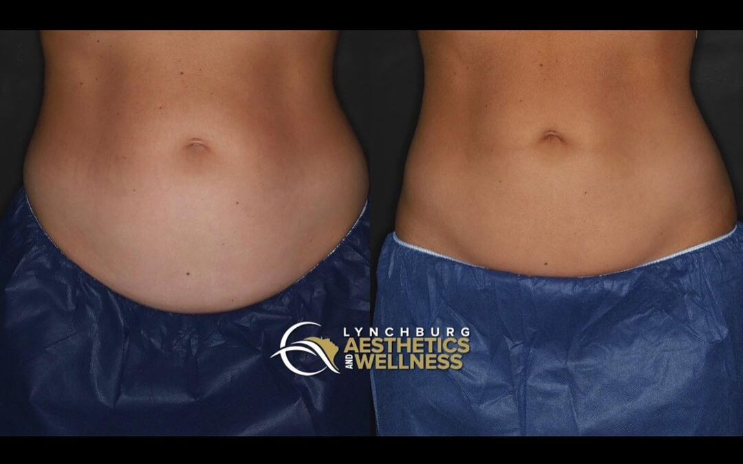 Result After 1 Round Of CoolSculpting