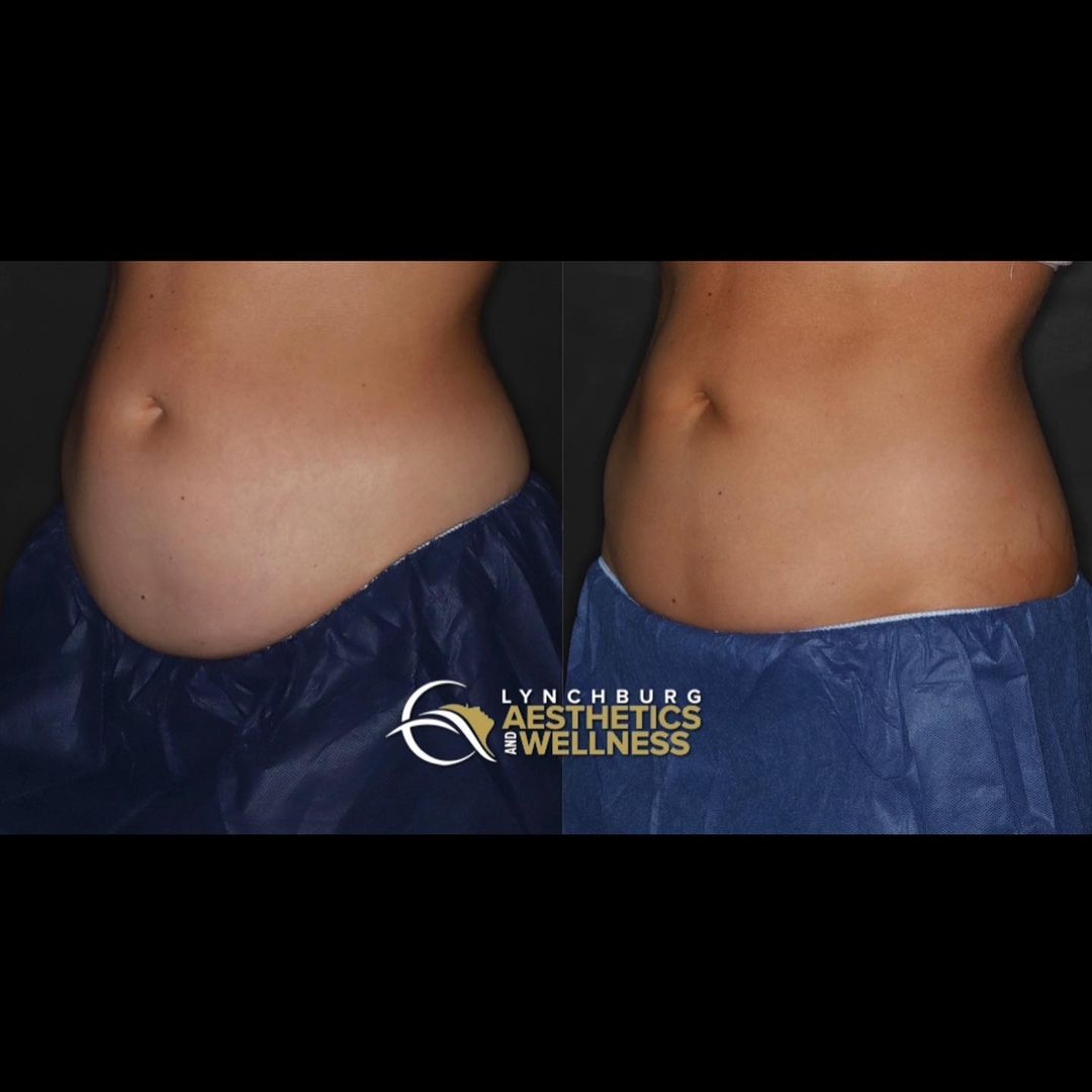lynchburg aesthetics st round coolsculpting side view