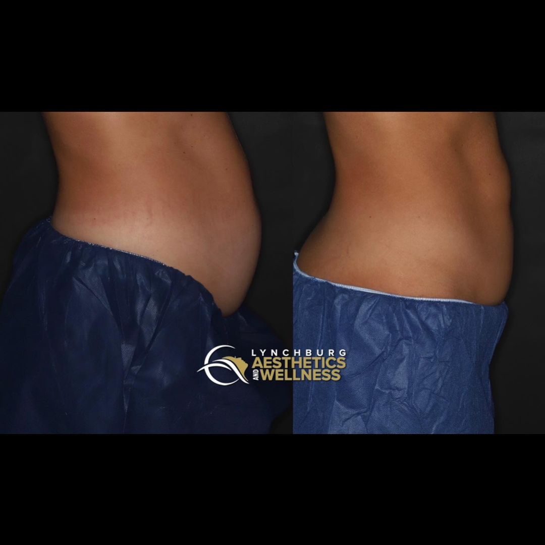 lynchburg aesthetics st round coolsculpting side view