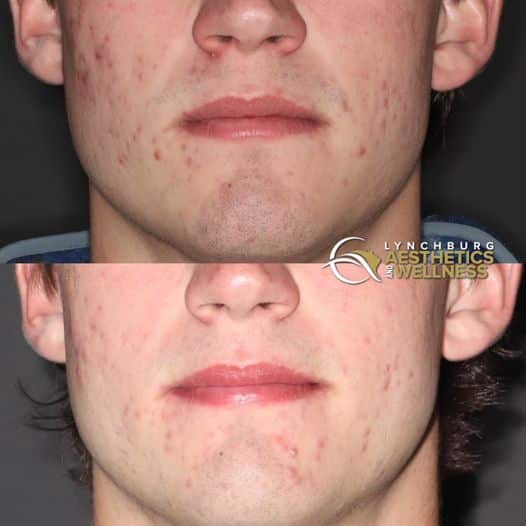 aviclear goodbye stuborn acne lynchburg aesthetics wellness casestudy a