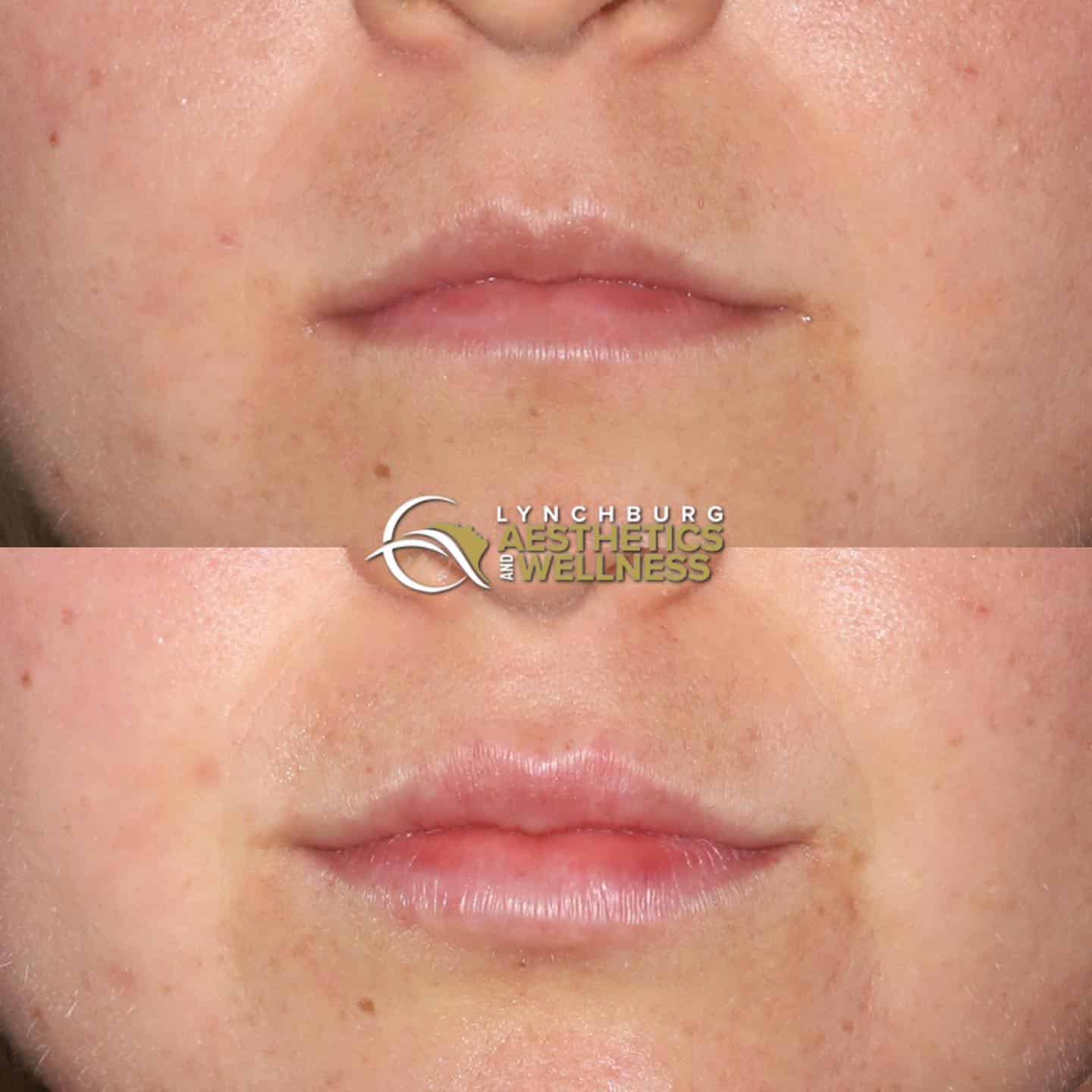 lip augmentation  lynchburg aesthetics wellness