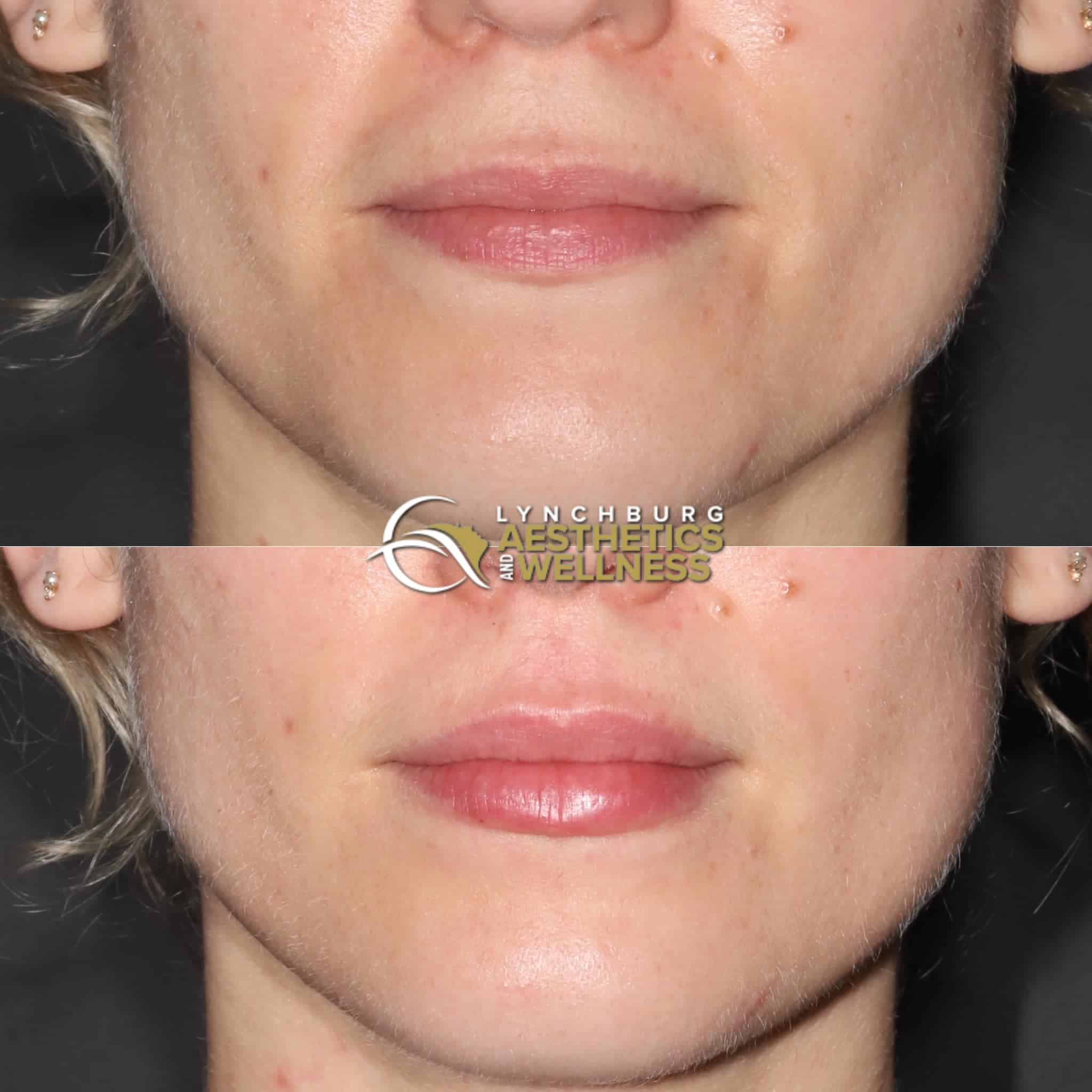lip augmentation case study  lynchburg aesthetics wellness