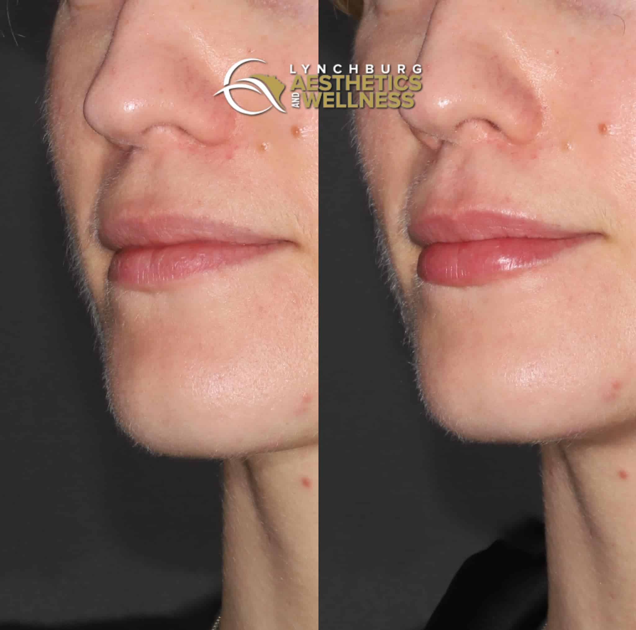 lip augmentation case study b lynchburg aesthetics wellness