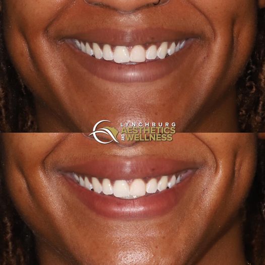 lip augmentation case study  lynchburg aesthetics wellness