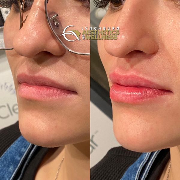lip augmentation case study b lynchburg aesthetics wellness