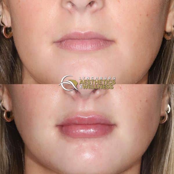 lip augmentation case study  lynchburg aesthetics wellness