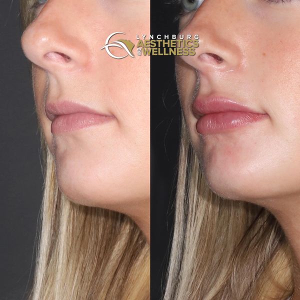 lip augmentation case study b lynchburg aesthetics wellness