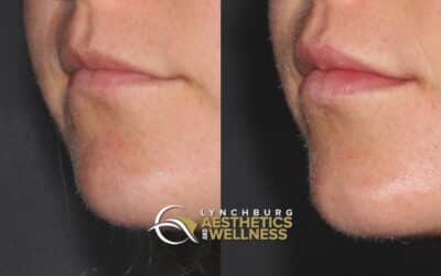 Natural lip augmentation for that subtle boost in hydration and pout