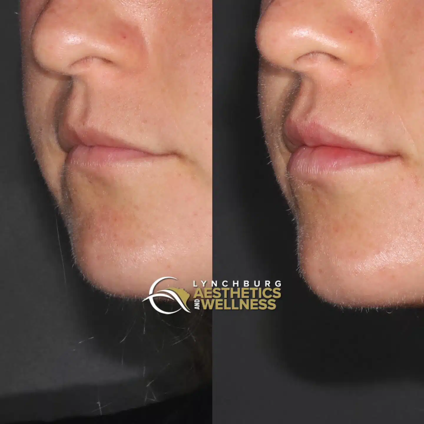lip augmentation lynchburg aesthetics wellness