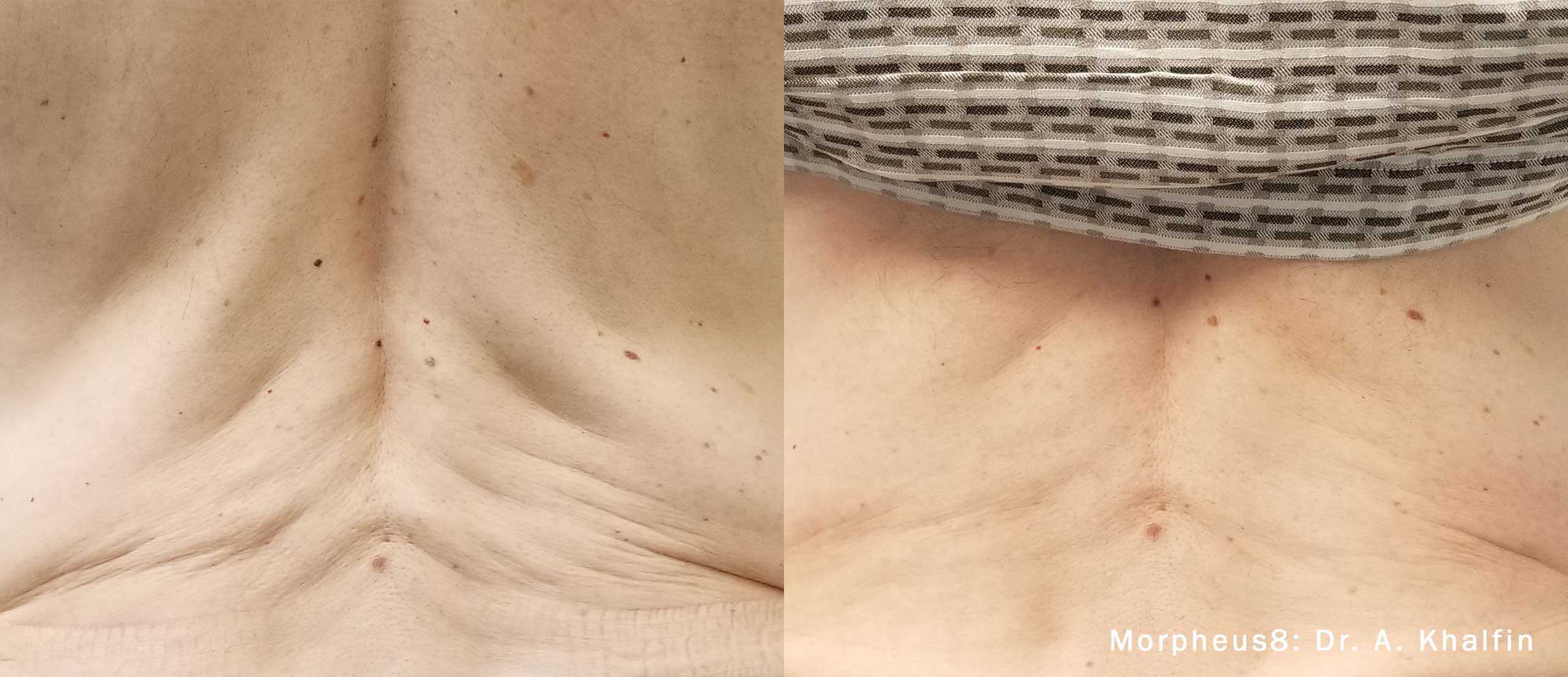 close up comparison showing before and after results of a morpheus skin treatment on the neck area the skin on the left appears with more fine lines and wrinkles while the right side shows smoother skin after the treatment text at the bottom reads morpheus dr a khalfin