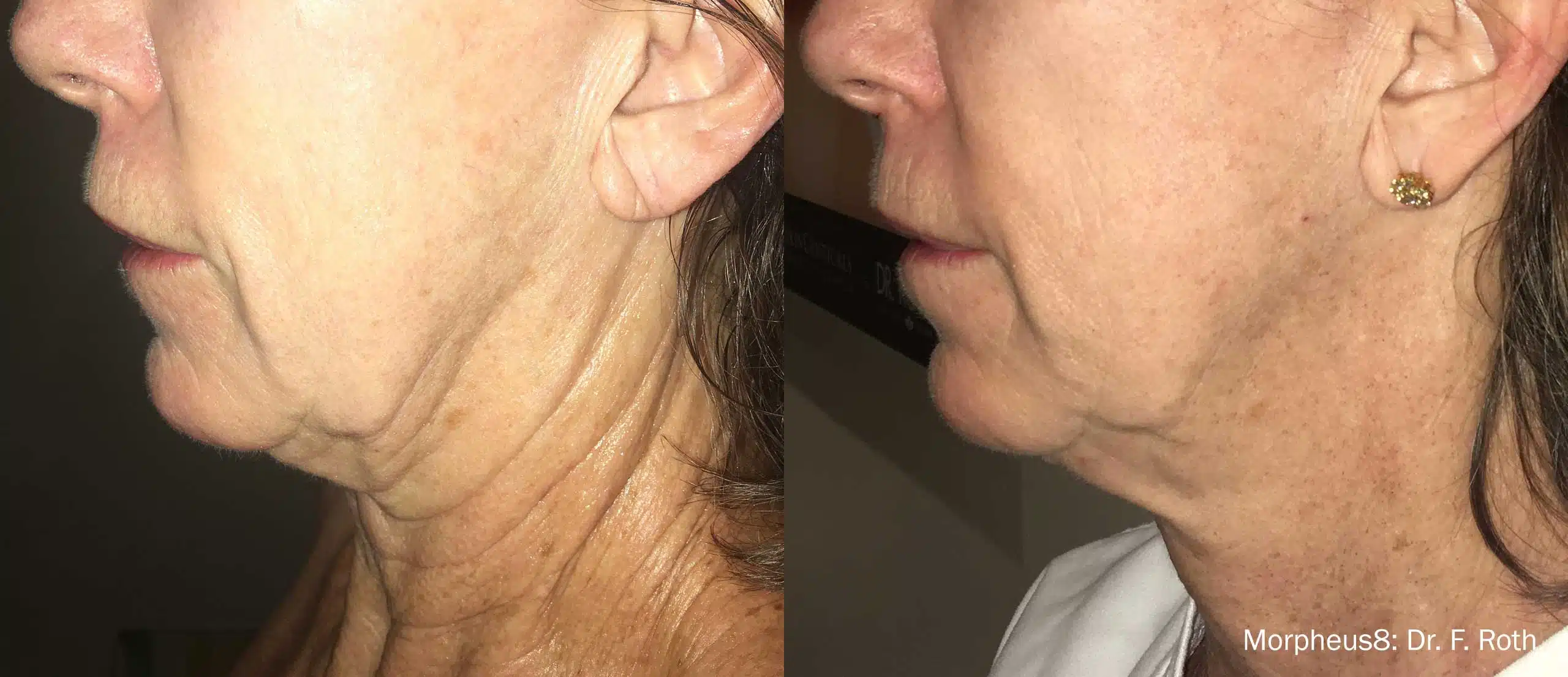 side by side photos showing the profile of a womans neck and jawline before and after treatment the left image shows sagging skin and wrinkles while the right image displays significantly smoother and tighter skin following rf microneedling text in the image morpheus dr f roth