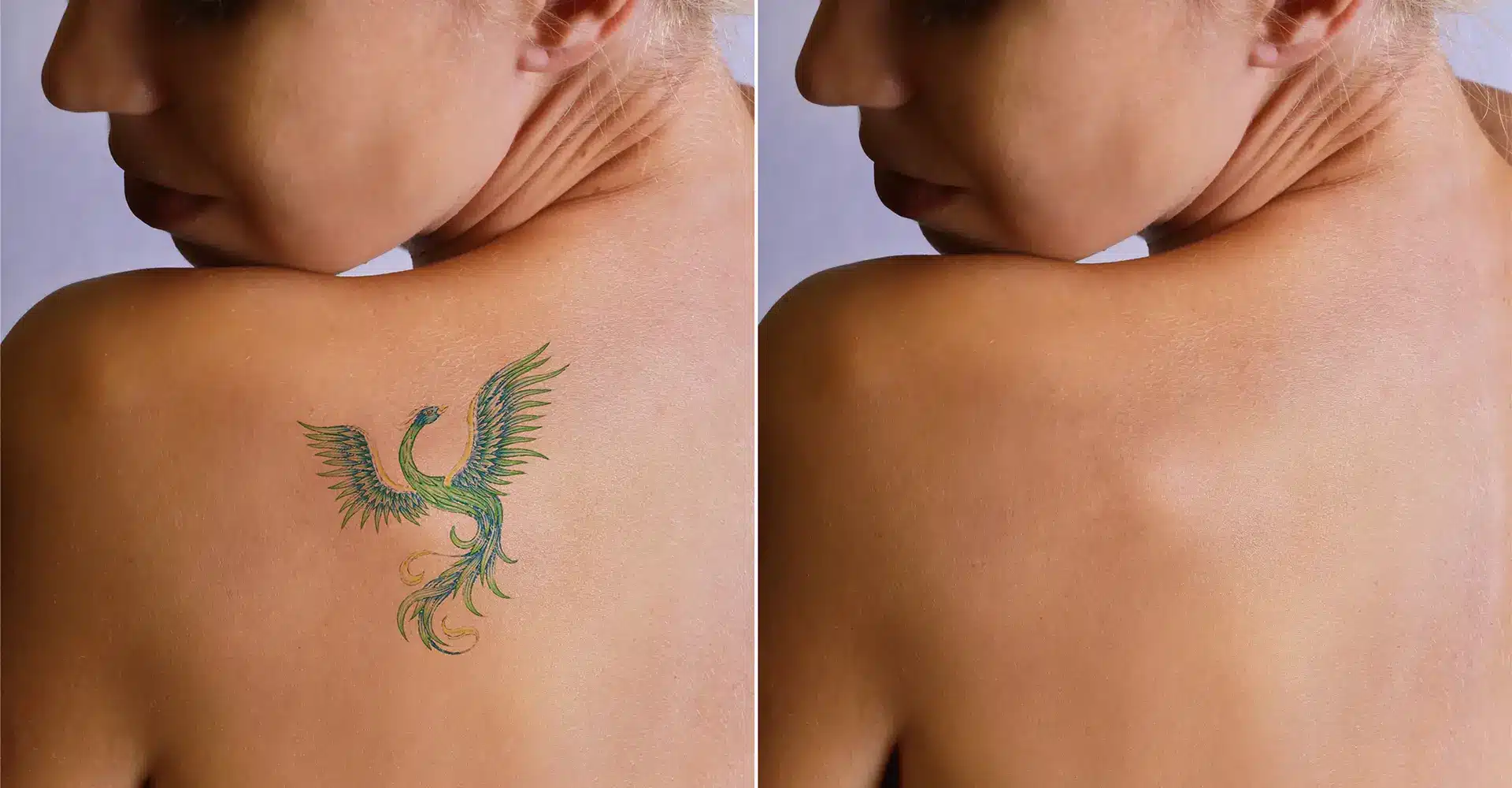 side by side images show a womans bare back the left image features a colorful phoenix tattoo on her shoulder blade while the right image reveals the same area after picoway tattoo removal leaving no visible marks