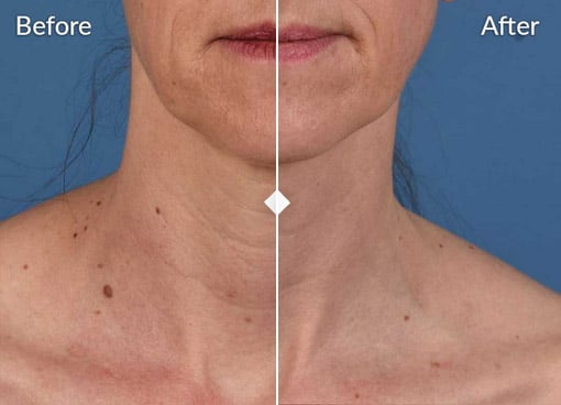 a side by side comparison of a persons neck and lower face showing before on the left and after on the right the before side depicts more wrinkles and age spots while the after side appears smoother with fewer wrinkles and spots highlighting the transformative effect of skinpen treatments