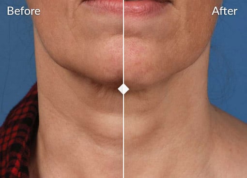 side by side comparison of a womans neck and lower face before and after a skinpen cosmetic treatment the left side labeled before shows sagging skin while the right side labeled after exhibits firmer smoother skin