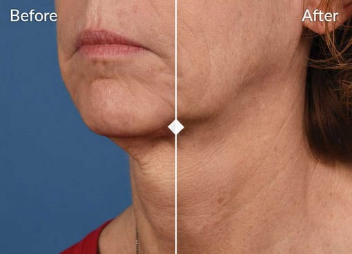 close up side by side comparison of a womans jawline and neck area before and after a skinpen cosmetic procedure the left side labeled before shows more wrinkles and sagging skin while the right side labeled after appears smoother and tighter