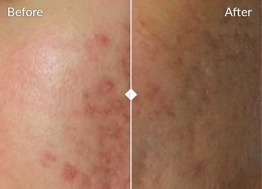 side by side comparison of skin before and after treatment the before side shows red inflamed and irritated skin with visible spots after applying skinpen treatment the after side shows significantly calmer and clearer skin with reduced redness and fewer visible spots