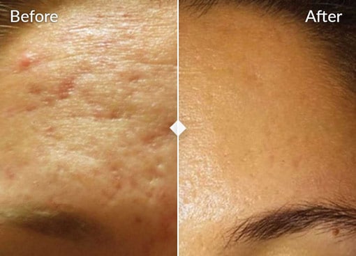 close up of a forehead showing a side by side comparison the left side labeled before has visible acne scars and uneven skin texture the right side labeled after skinpen treatment shows significantly smoother and clearer skin with reduced acne scars