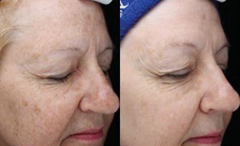 side by side comparison showing a womans skin before and after a bbl treatment the left image depicts skin with visible spots and uneven texture while the right image shows smoother clearer and more evenly toned skin