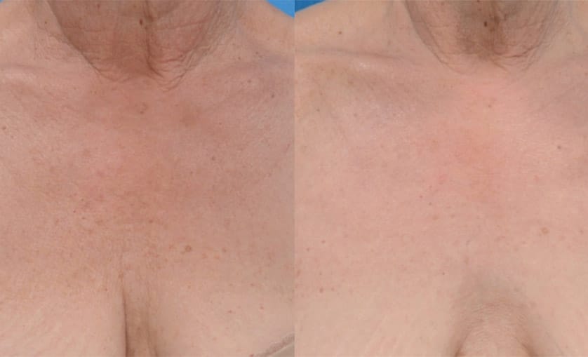 before and after images showing the chest area of an individual the left image shows skin with visible age spots and uneven texture in the right image likely after a bbl treatment the skin appears smoother and has fewer visible age spots indicating a significant improvement