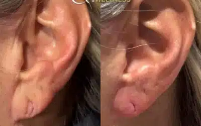 Earlobe Rejuvenation in Lynchburg: Fix Sagging, Wrinkled Earlobes