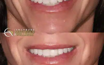 Surgical Lip Correction in Lynchburg: Fixing Bad Filler Results